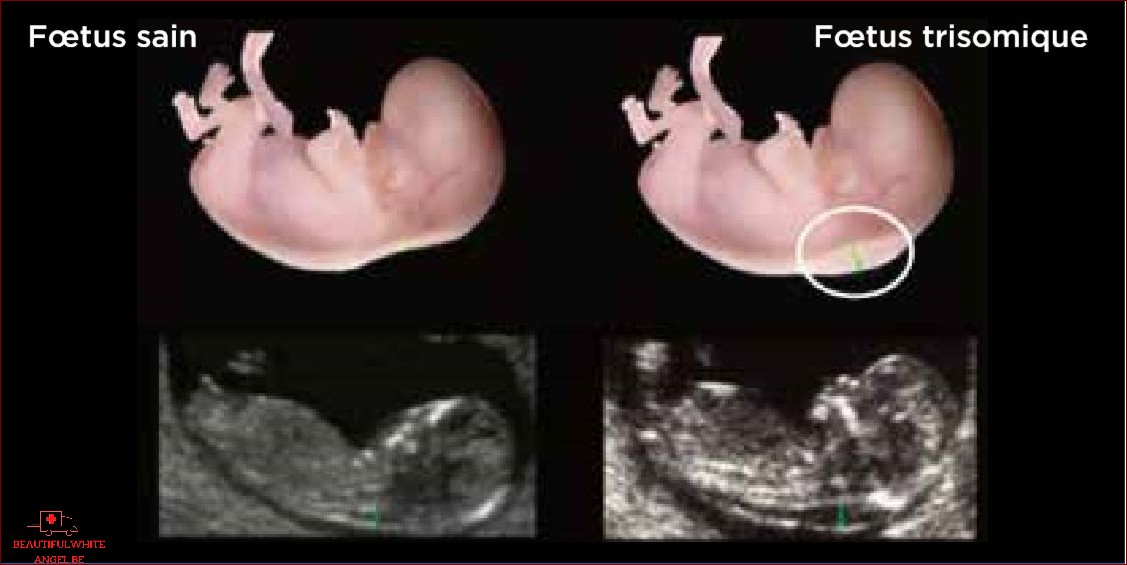 Clarté nucale et trisomie 21- Mesure de la clarté nucale du fœtus