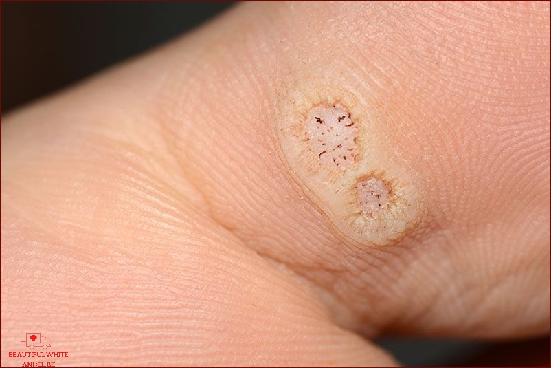 Comment reconnaître une verrue Maladie de peau comment reconnaître les différents symptômes cutanés