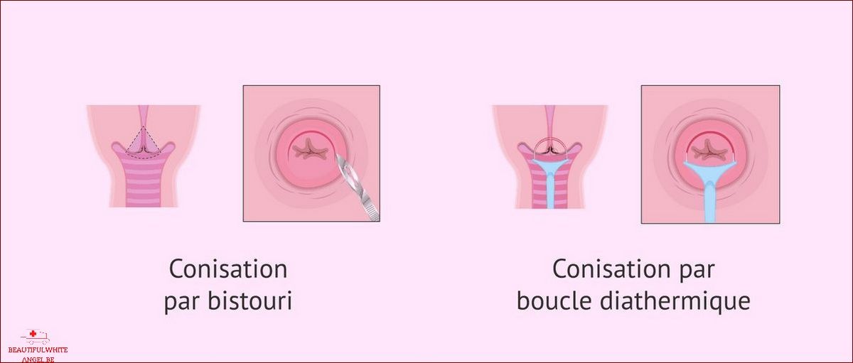 Conisation du col de l utérus - Cancer du col utérin