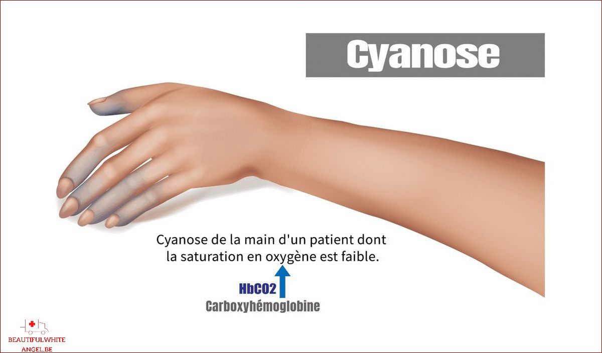 Cyanose causes conséquences et traitement