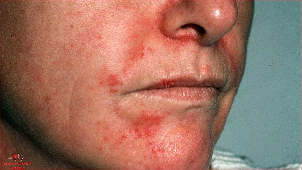 Dermatite dermite séborrhéique les traitements naturels