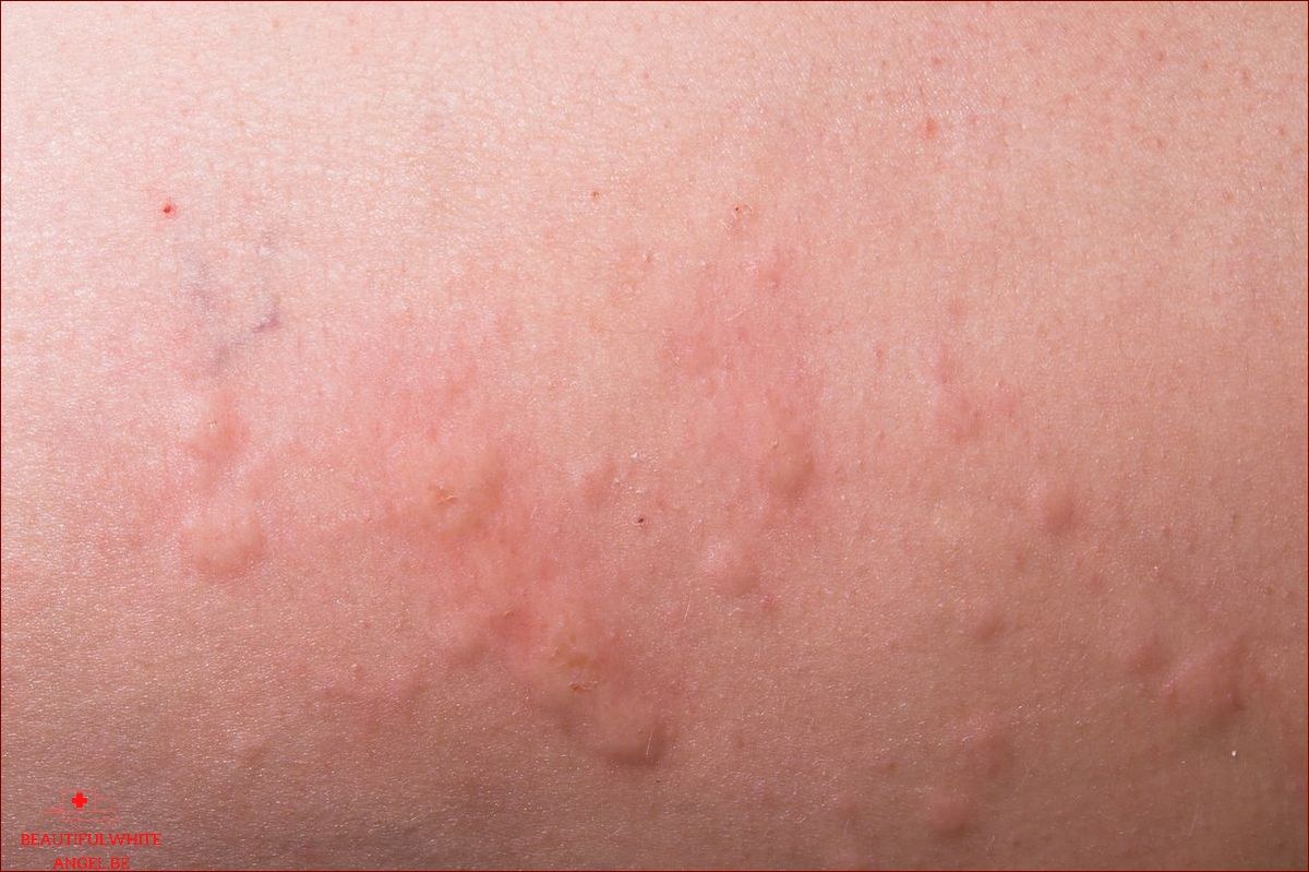 Différentes formes d allergie cutanée les distinguer