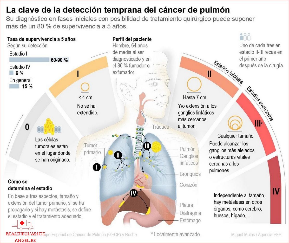 Les différents types et stades de cancer du poumon