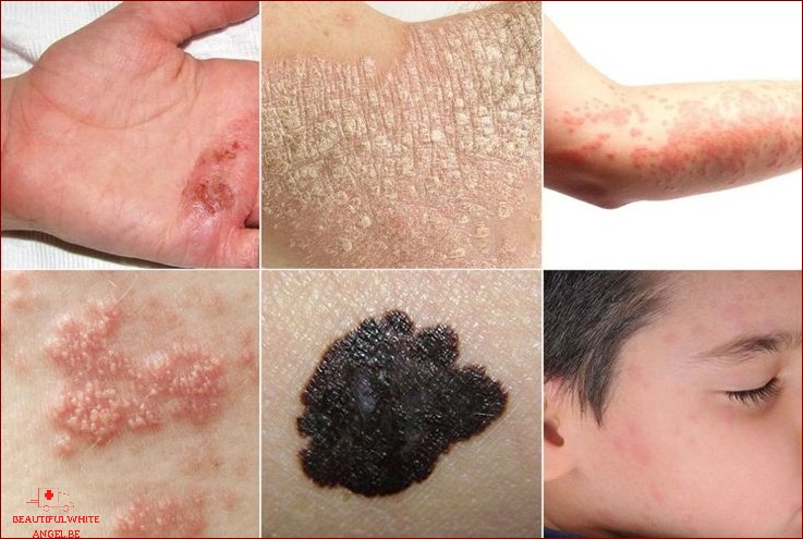 Maladie de peau comment reconnaître les symptômes cutanés